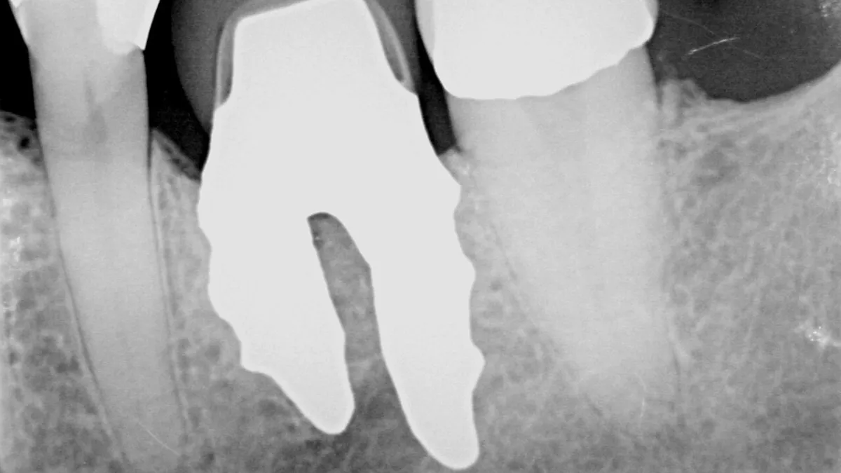 Dental X-ray showing implants
